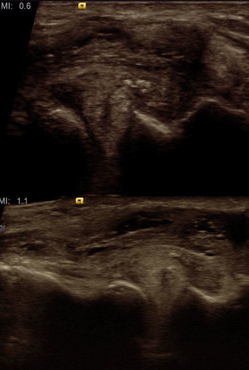 Figure 2 for case horizontal cleavage tear of the lateral meniscus